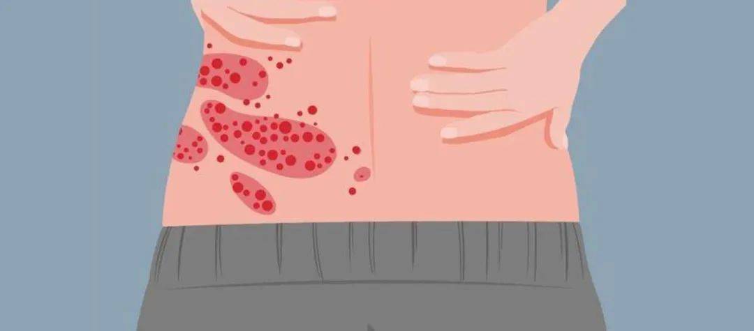 皇冠信用网会员开户_一旦感染终身携带皇冠信用网会员开户!深圳疾控提醒:这4类人要注意