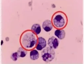 皇冠会员如何申请_突然确诊皇冠会员如何申请!90后女子傻眼:不痛也不痒……很多人发现就是晚期