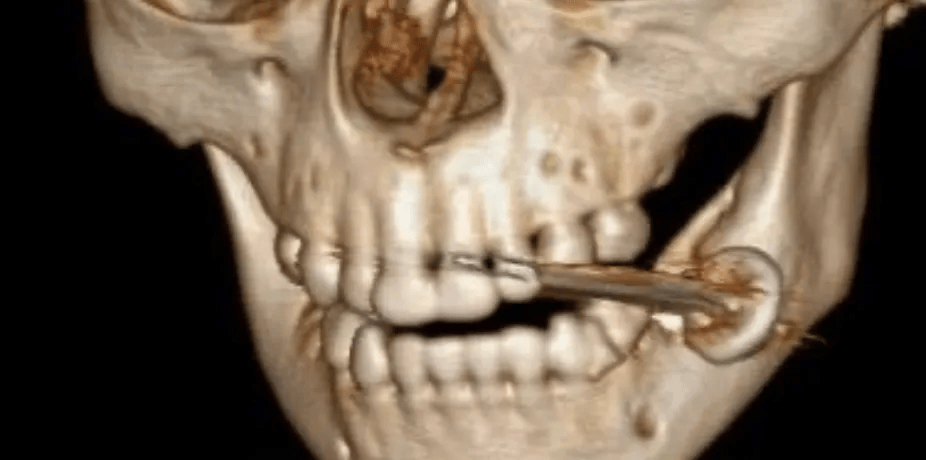 怎么注册皇冠信用網_2岁孩子一口咬下瞬间爆炸!几乎家家都有怎么注册皇冠信用網,务必警惕