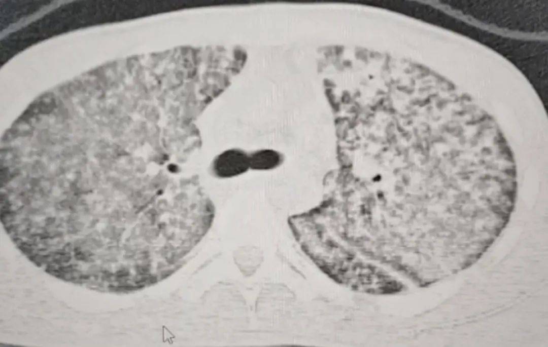 如何代理皇冠信用盘
_河南一大学生咳嗽发烧近一月如何代理皇冠信用盘
,多家诊所误当感冒治,医生:肺已全白