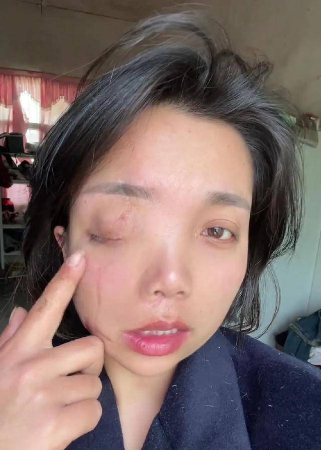 皇冠信用网在哪里开通
_安徽女子左眼失明皇冠信用网在哪里开通
，办理残疾人证被拒？残联：双眼残疾可办理