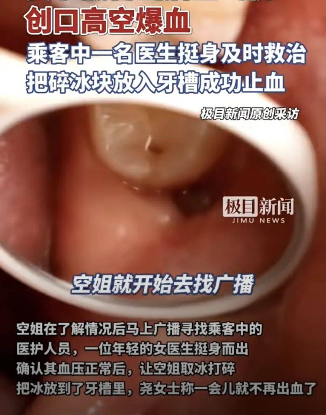 皇冠信用盘庄家
_高空惊魂皇冠信用盘庄家
！女子拔智齿后坐飞机嘴里突然开始冒鲜血……医生紧急提醒