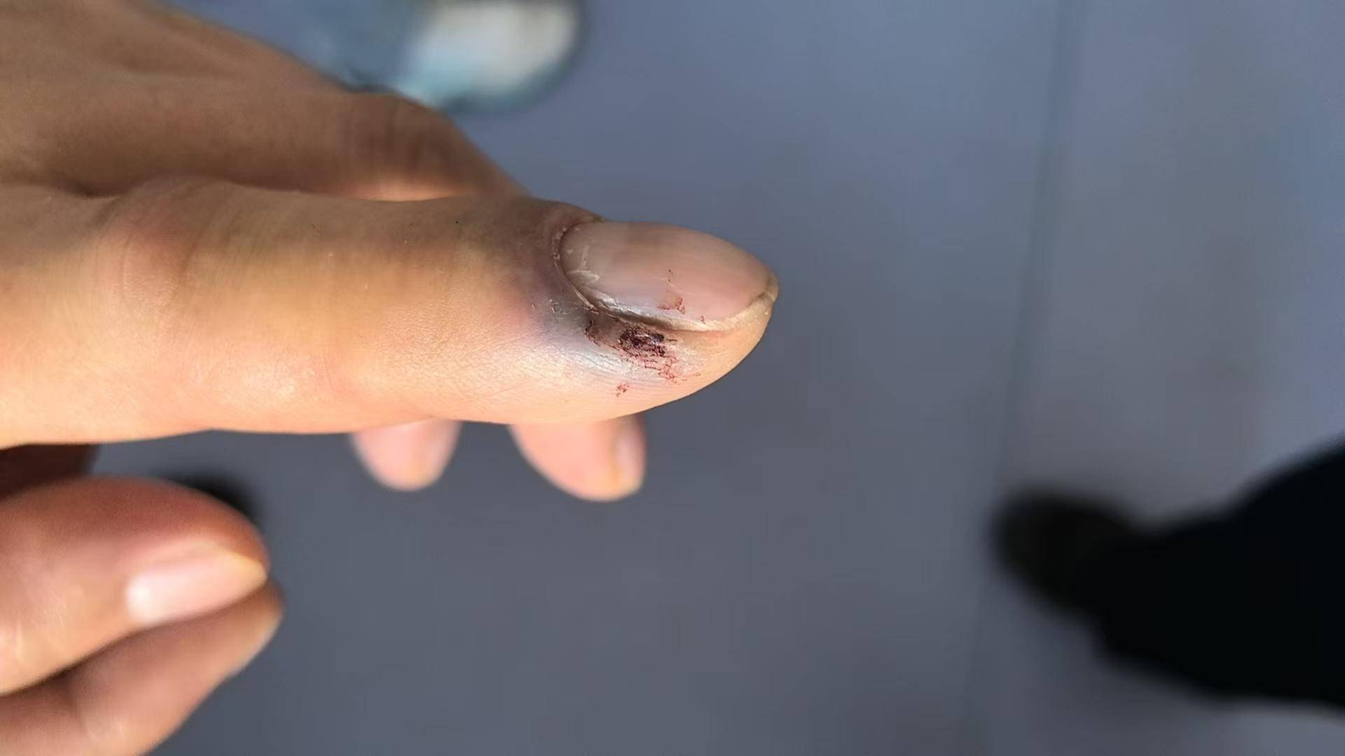 皇冠信用会员账号注册_青海一男子被罕见剧毒阿拉善蝮蛇咬伤皇冠信用会员账号注册，因无血清一度想放弃治疗 警车开道转运700公里救命