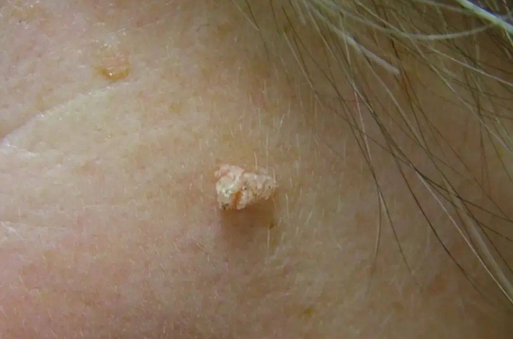 皇冠信用網在哪里开通
_脖子上长出的小肉粒皇冠信用網在哪里开通
，能揪吗？