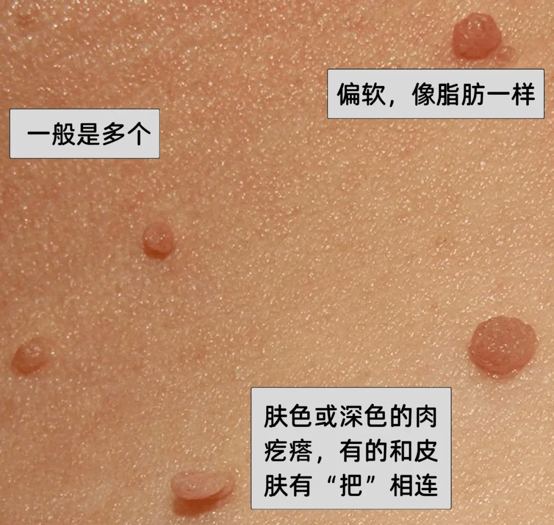 皇冠信用網在哪里开通
_脖子上长出的小肉粒皇冠信用網在哪里开通
，能揪吗？