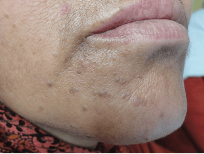 皇冠信用網在哪里开通
_脖子上长出的小肉粒皇冠信用網在哪里开通
，能揪吗？