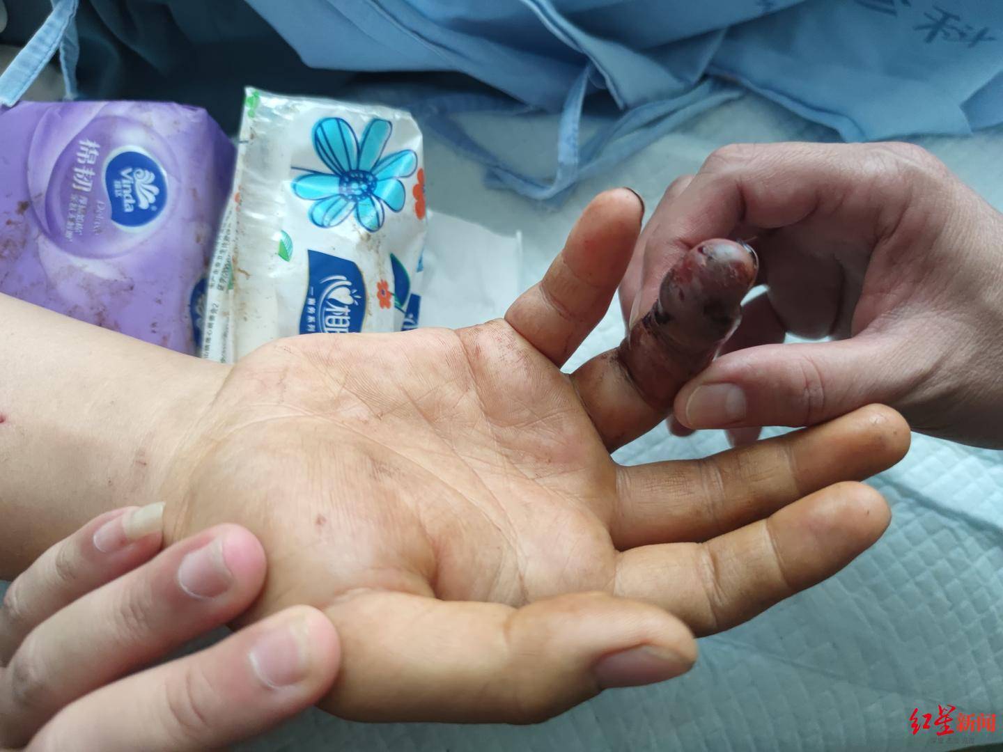 丹麦丙组联赛_男子被毒蛇咬伤拦车自救丹麦丙组联赛？当事人讲述：当时可能把手指直接伸向了蛇嘴里